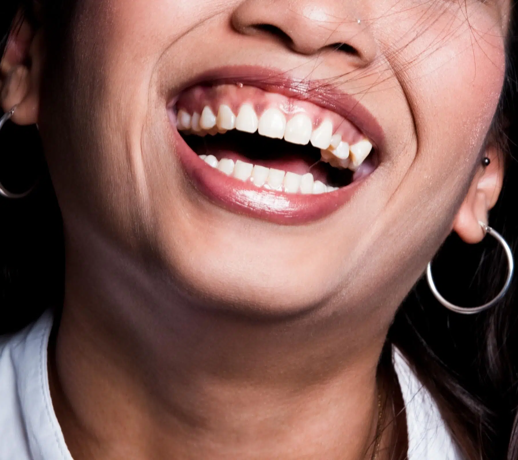上唇垂直長度過短也會影響笑齦