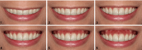 牙齒外露的多寡對笑容美觀深具影響