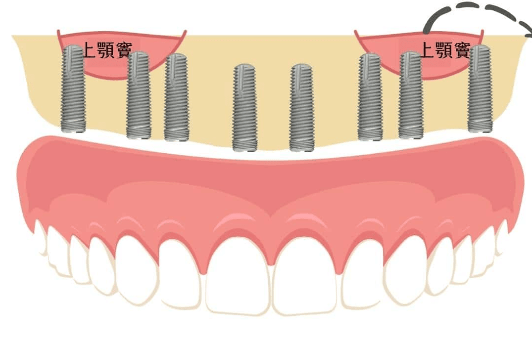 全口植牙施做