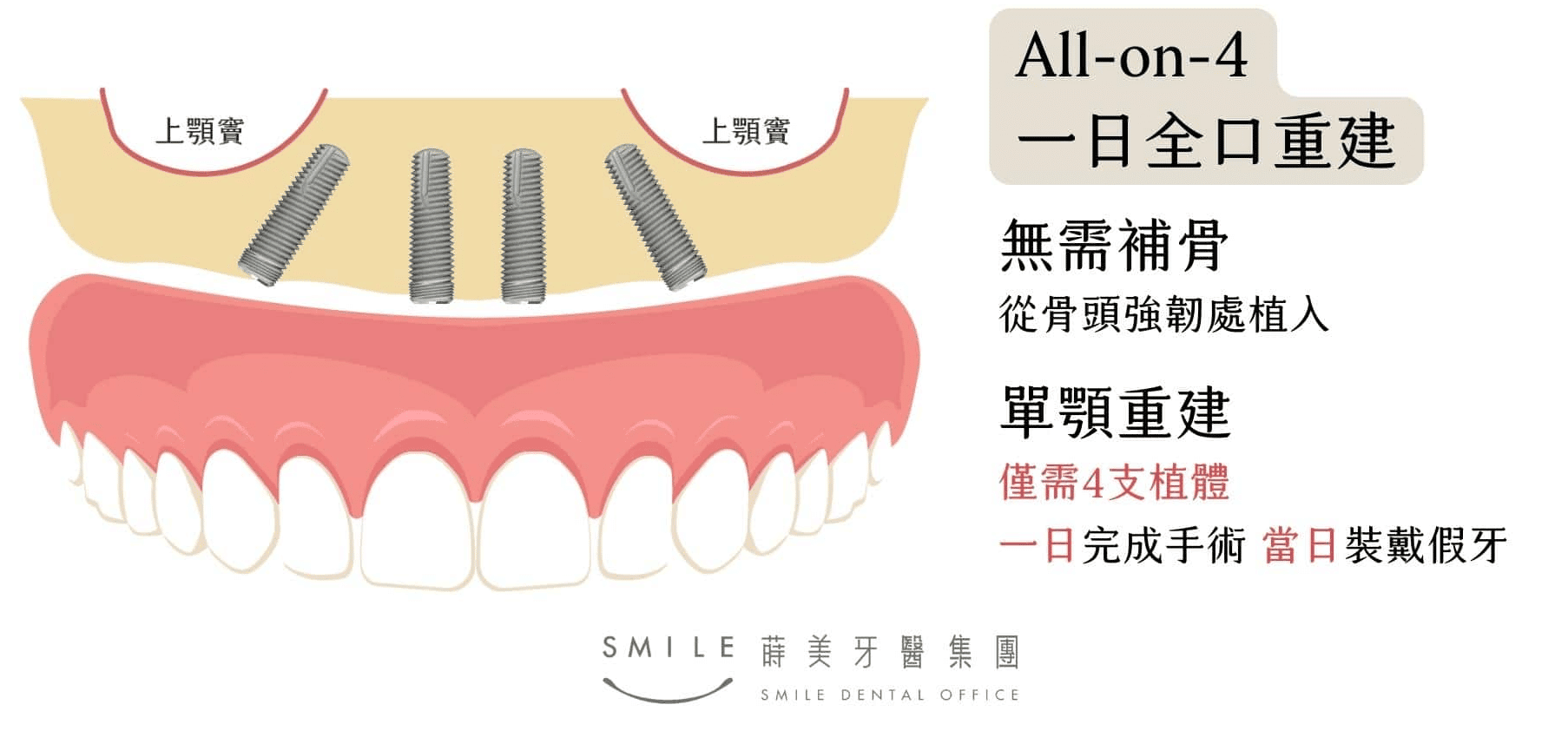 全口植牙All-on-4施做