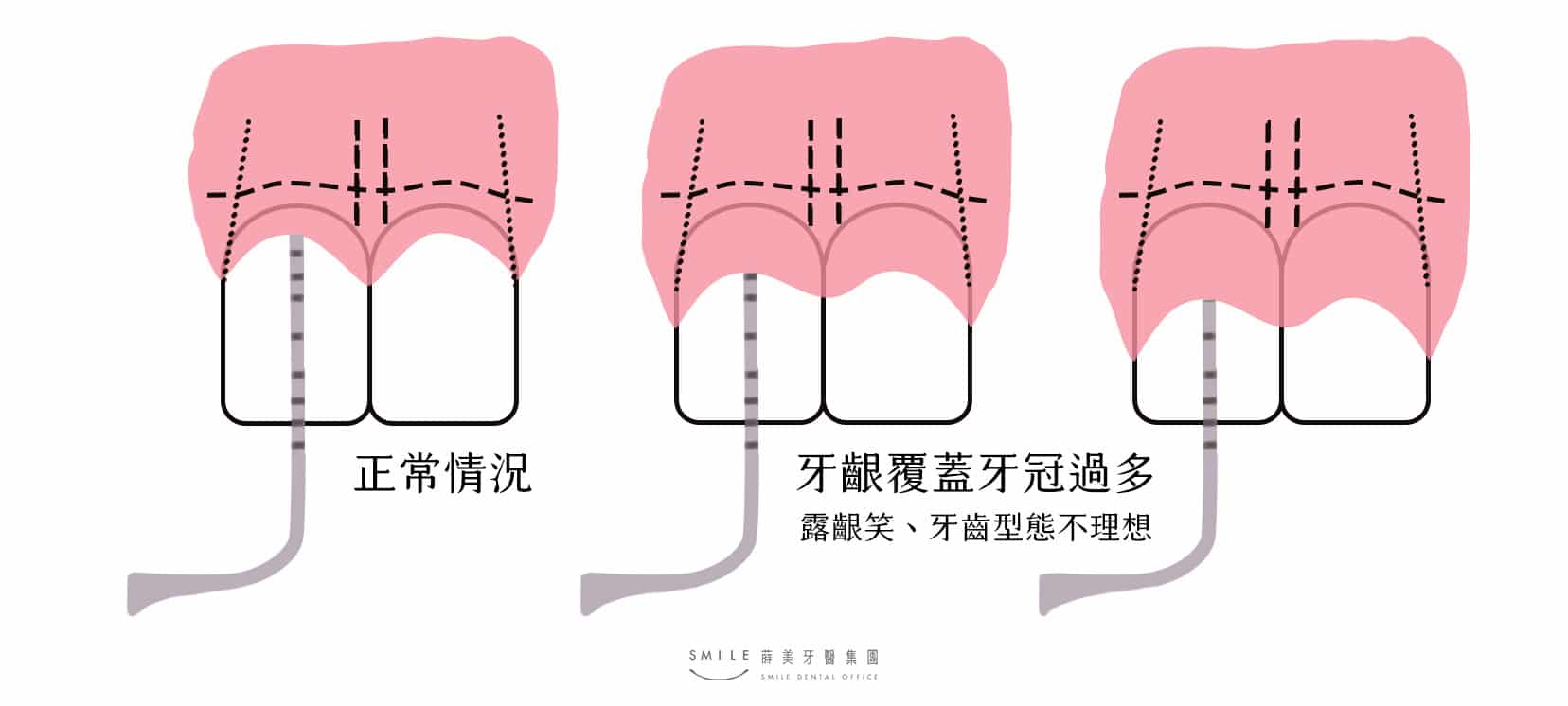 牙齦外露手術是什麼