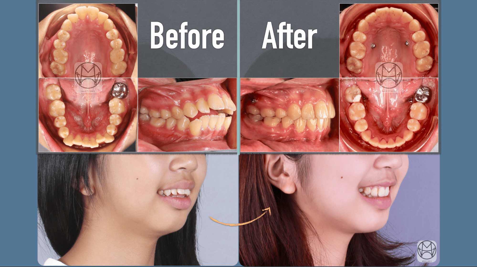 矯正打骨釘可幫助改善前牙開咬症狀