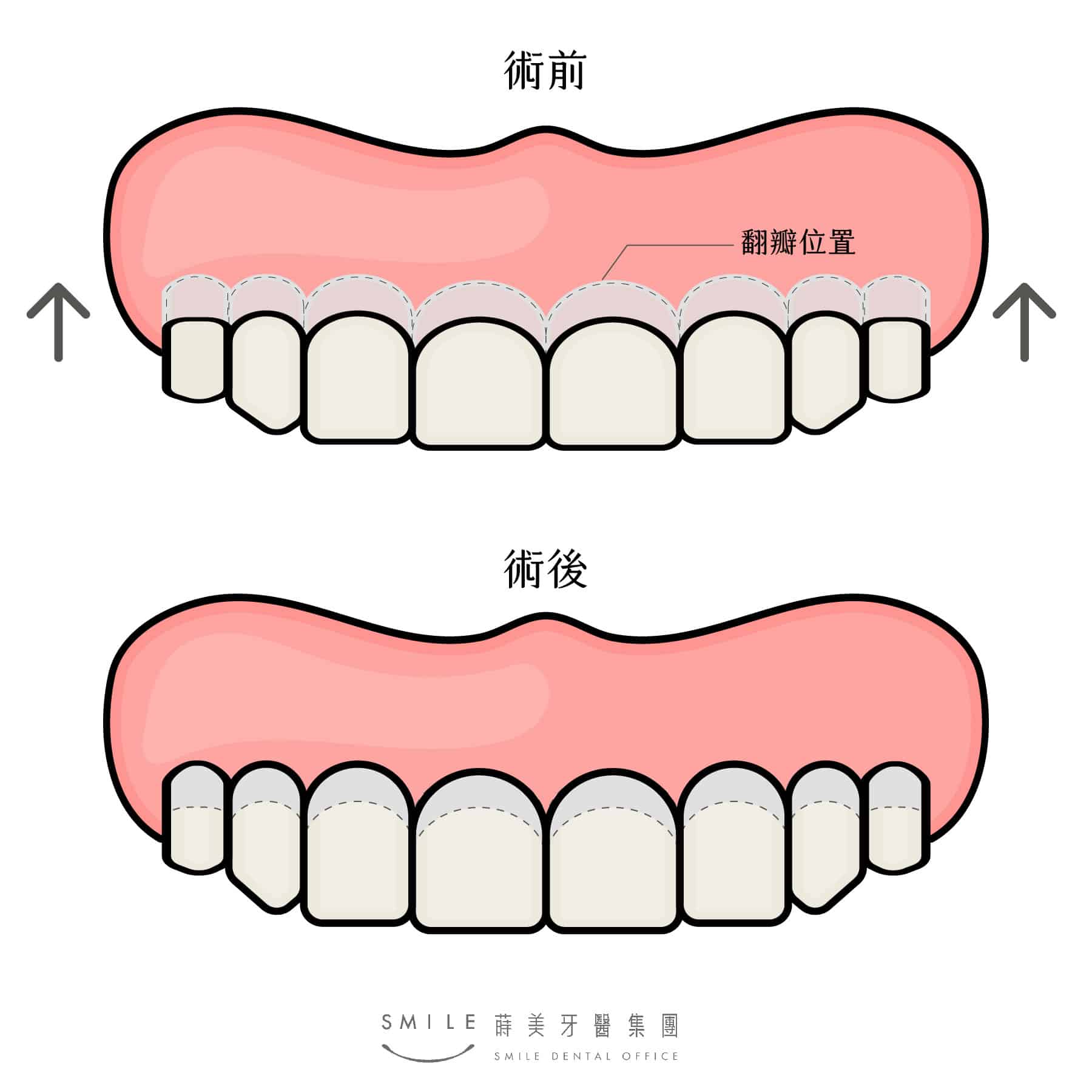 牙齦外露怎麼辦？