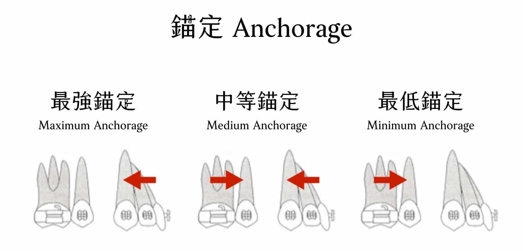 矯正打骨釘可產生錨定作用