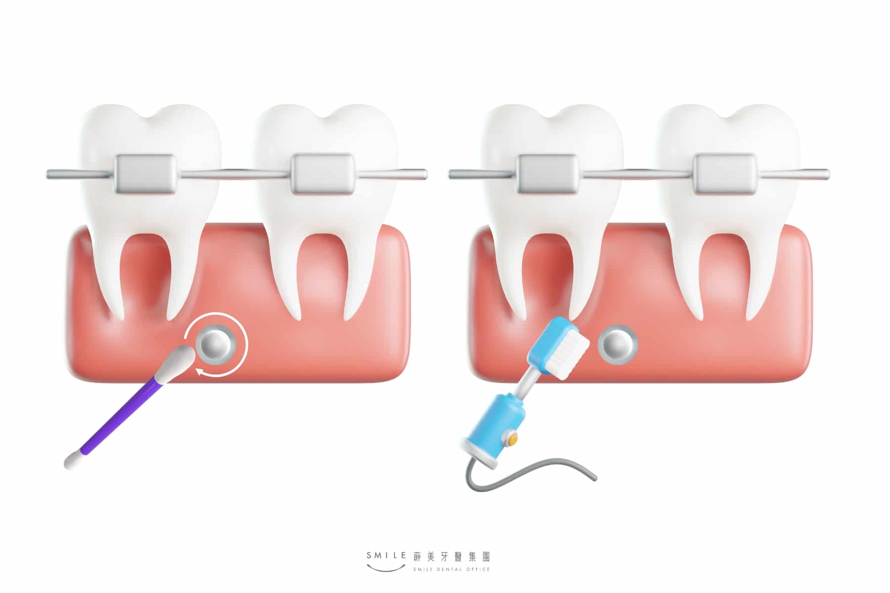 矯正打骨釘後該妥善清潔才能保護牙齒健康