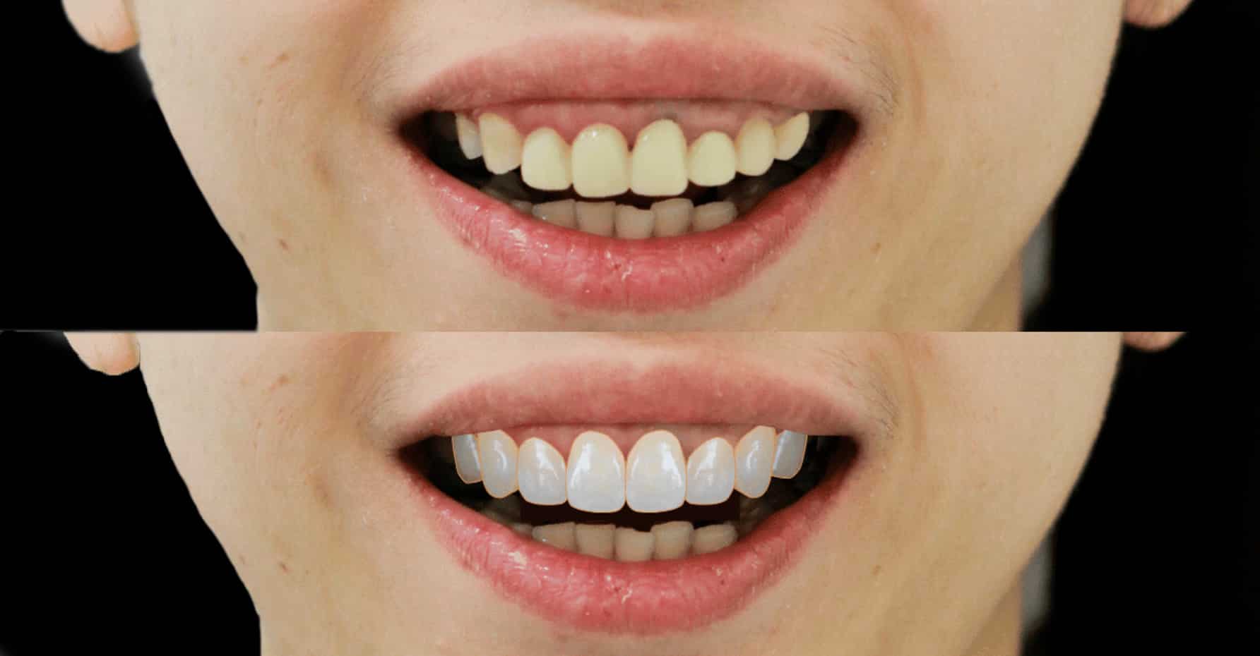 牙齦外露手術可改善笑齦問題
