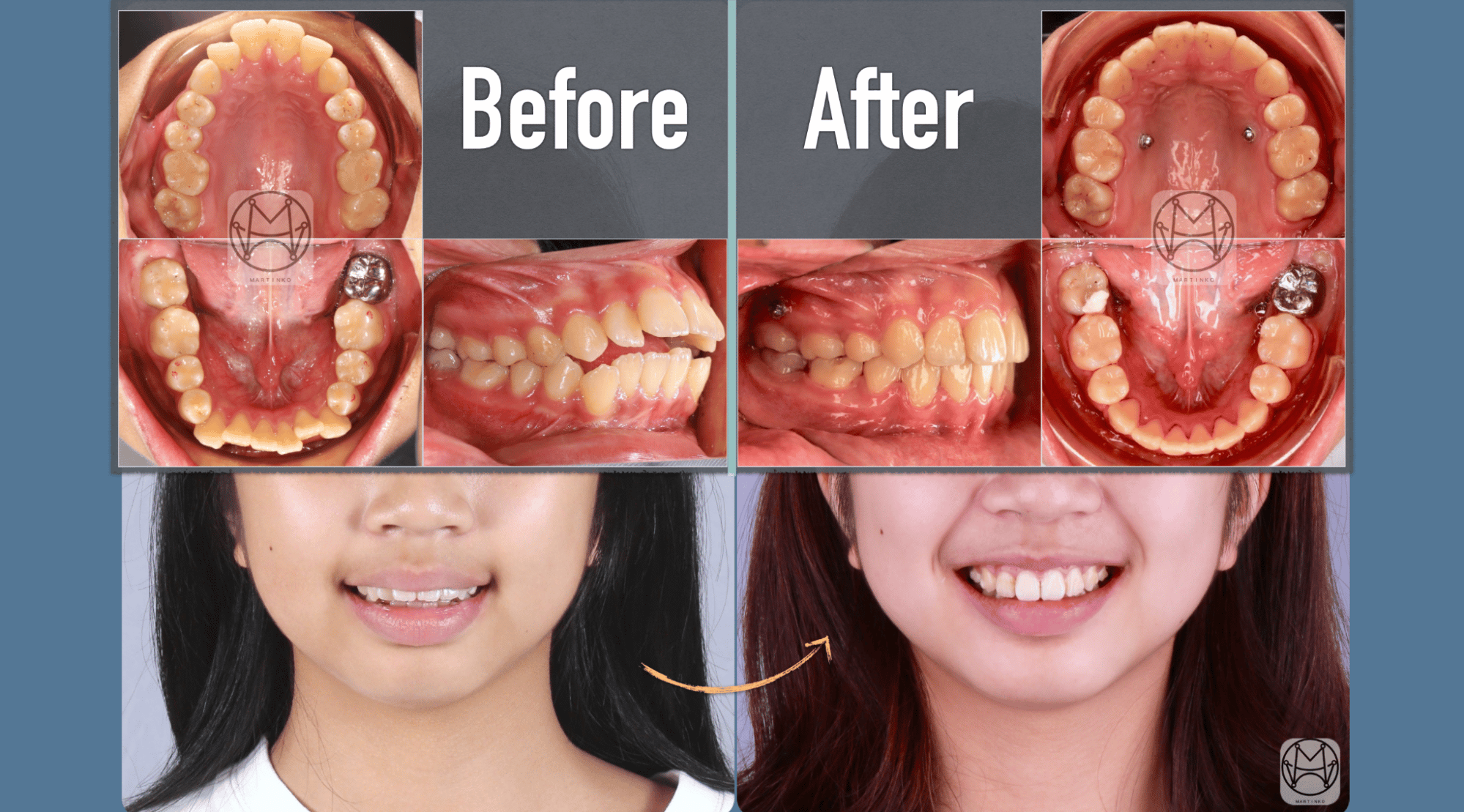 矯正打骨釘可幫助改善前牙開咬