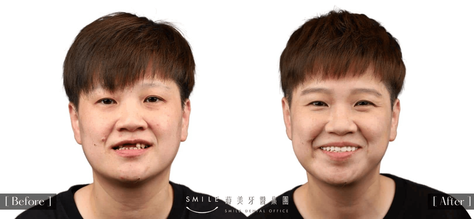 全口重建1