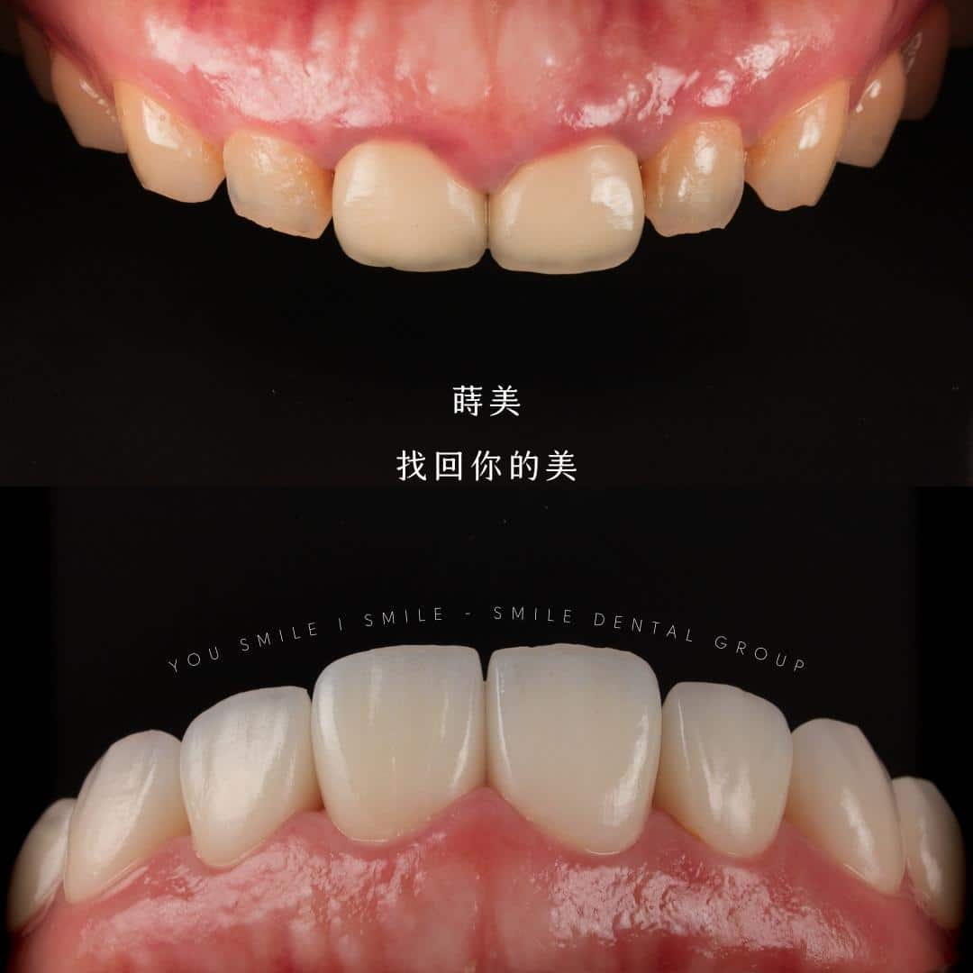 全瓷貼片案例 蒔美牙醫#119-16