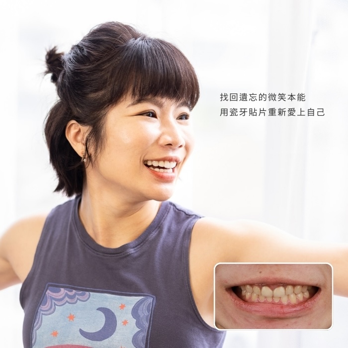 找回遺忘的微笑本能，用瓷牙貼片重新愛上自己 ｜板橋瓷牙貼片推薦