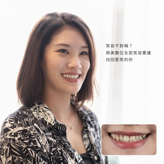 笑容不對稱？蒔美數位全瓷笑容重建，找回愛笑的你