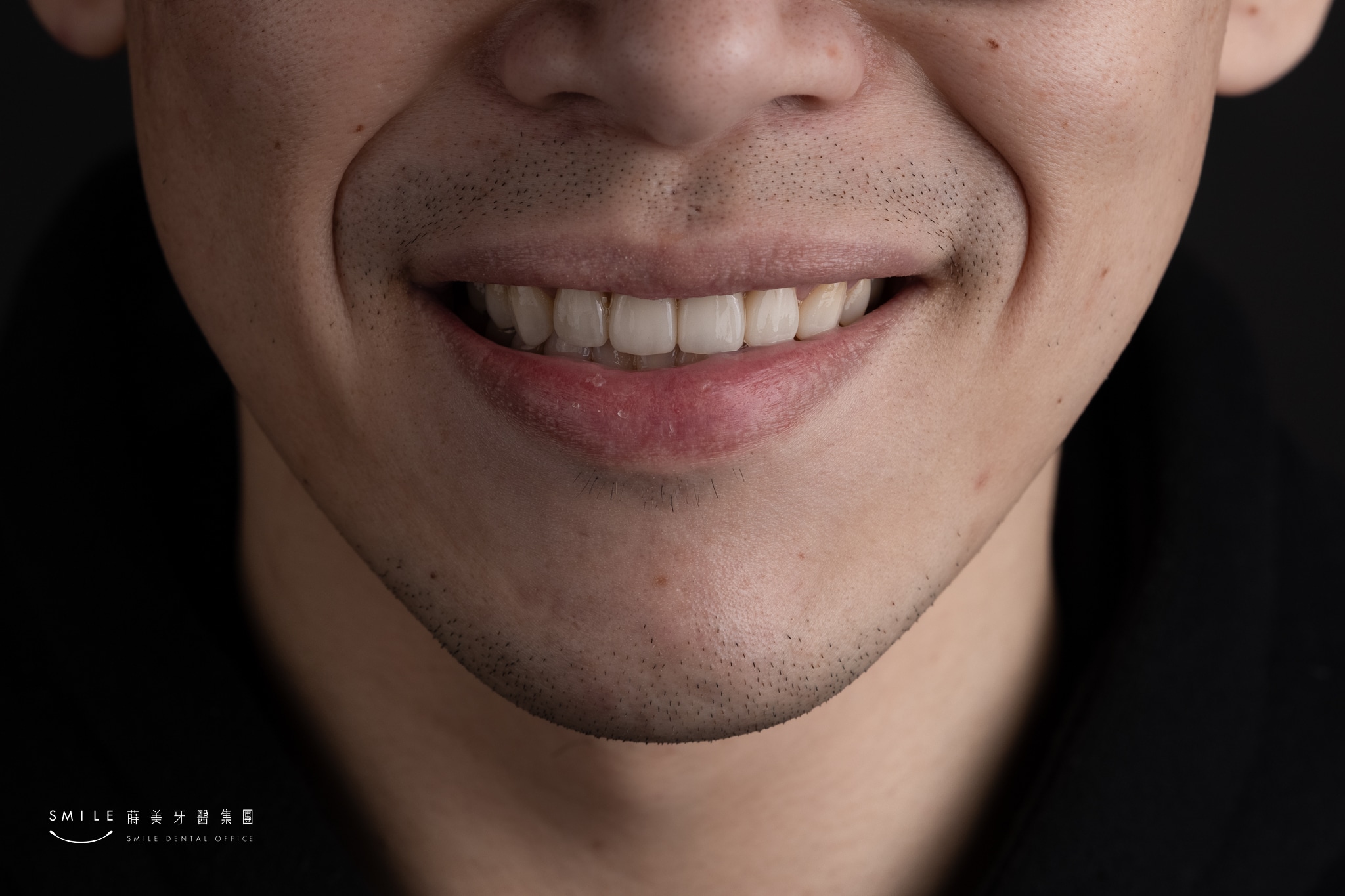牙齒美白之前先瞭解牙齒變黃的原因