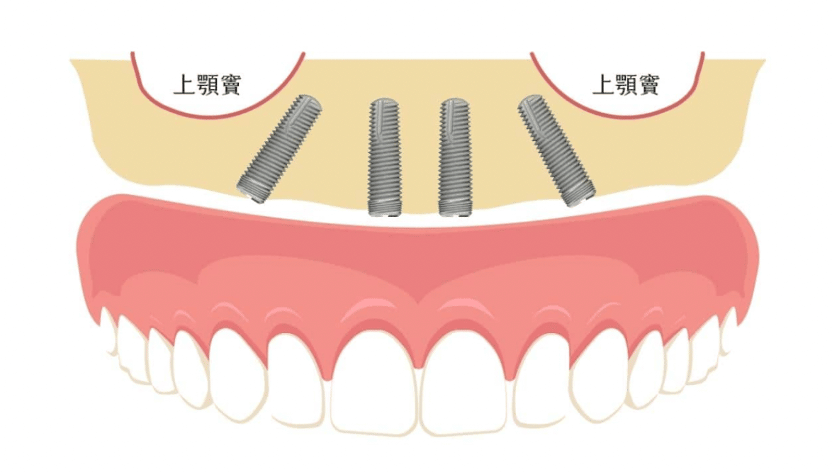 All-on-4一日全口重建速定植牙【台北新北牙醫】蒔美牙醫集團｜All-on-4全口重建/植牙專科醫師團隊