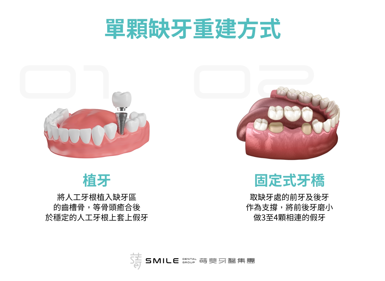 單顆缺牙重建方式