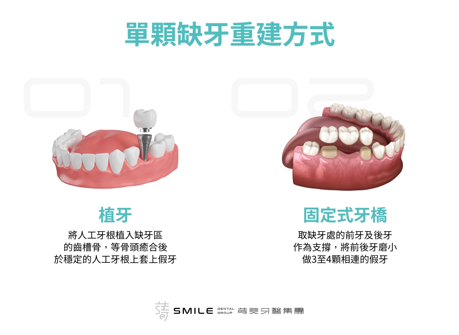 單顆植牙重建方法 植牙原理：植牙結構像天然牙齒｜台北新北蒔美牙醫集團｜All-on-4全口重建/植牙專科醫師團隊