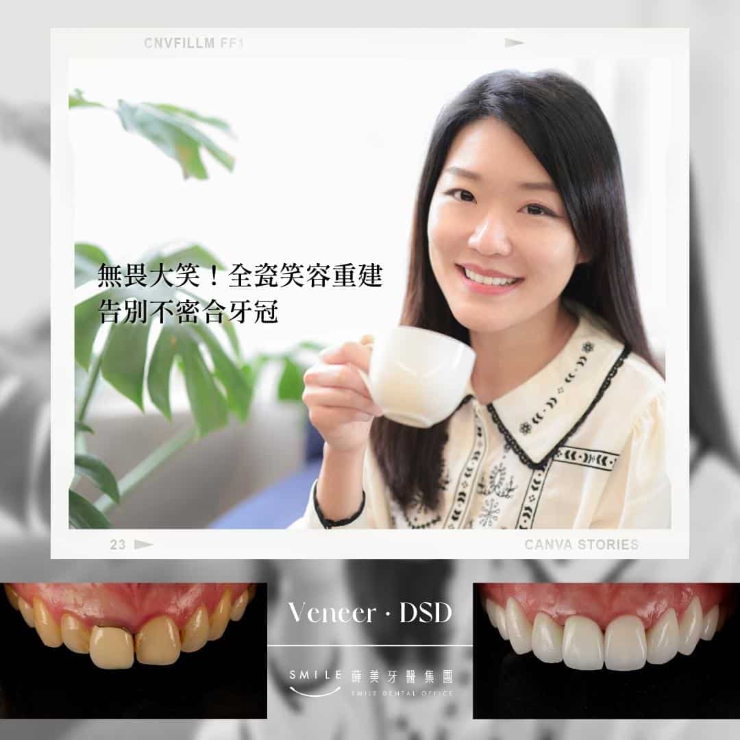 全瓷貼片案例 蒔美牙醫#122