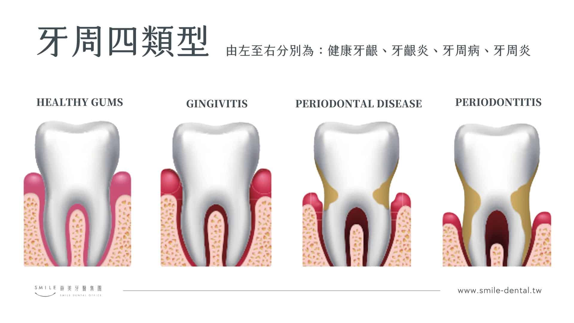 牙周四類型