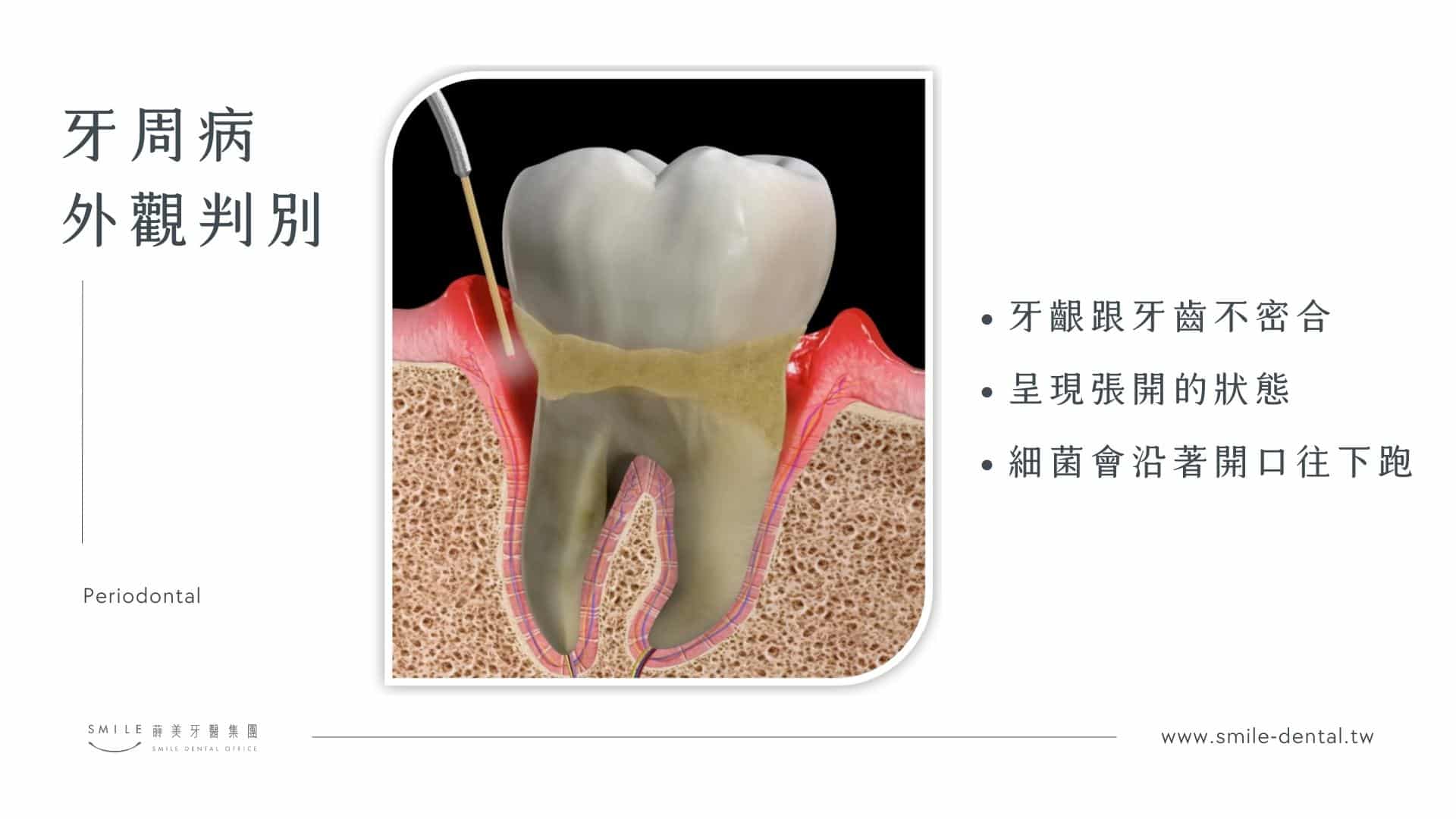 牙周病是什麼