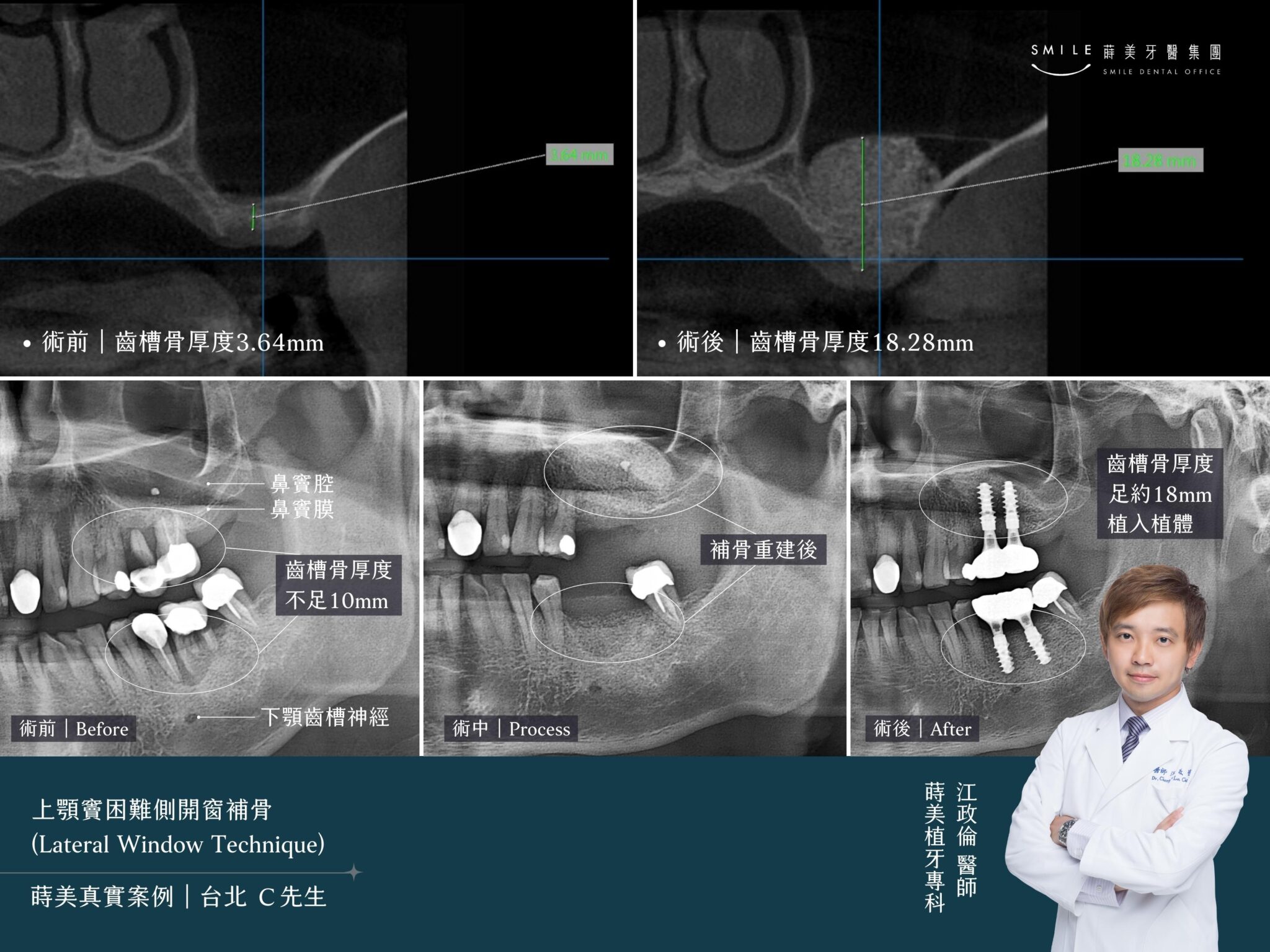 補骨手術大集合