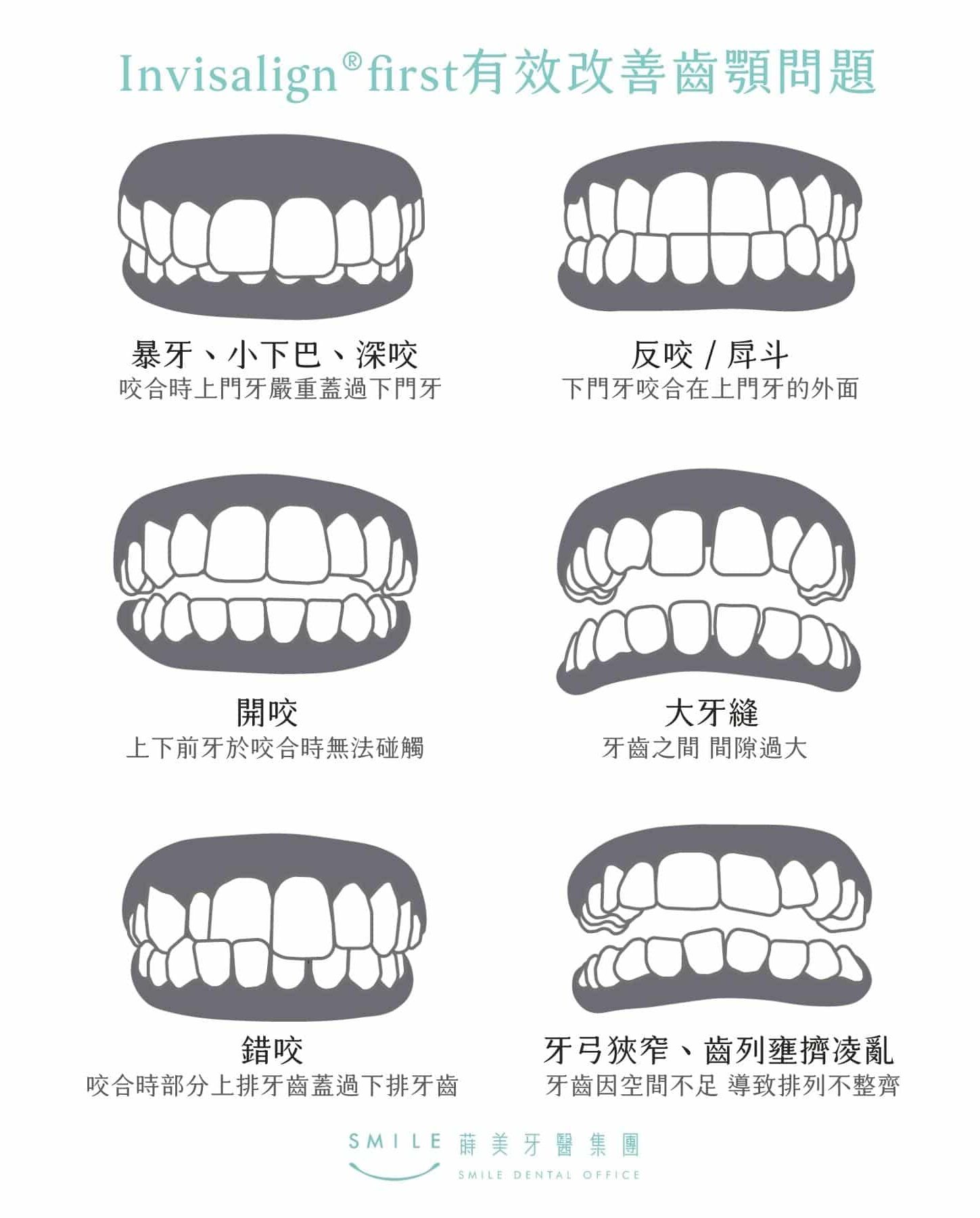 Invisalign®first有效改善齒顎問題