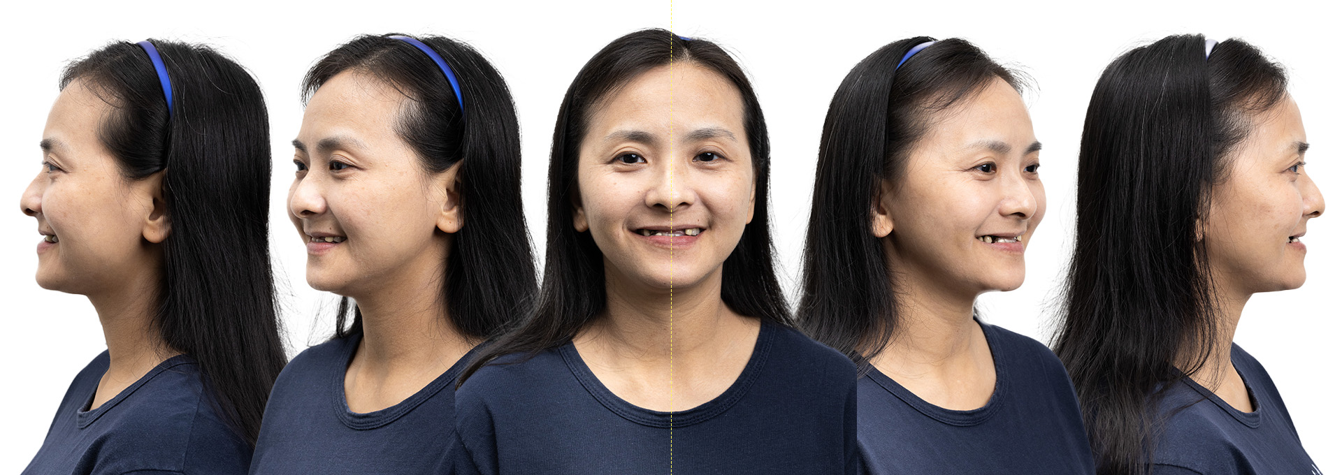 All-on-4 案例-蒔美牙醫-患者各角度術前照