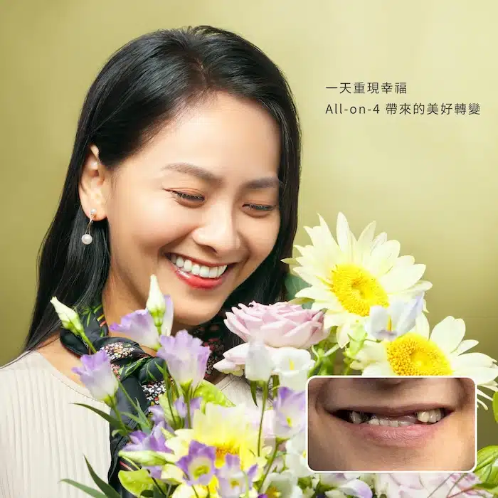 一天重現幸福，All-on-4 帶來的美好轉變