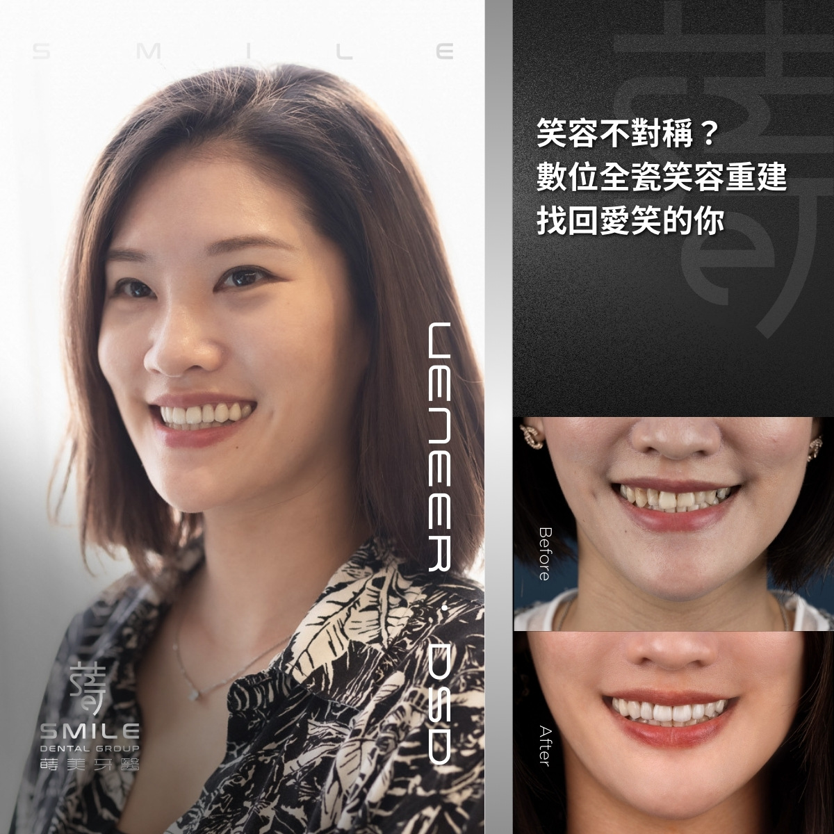 全瓷貼片案例-台北陶瓷貼片推薦-蒔美牙醫-11