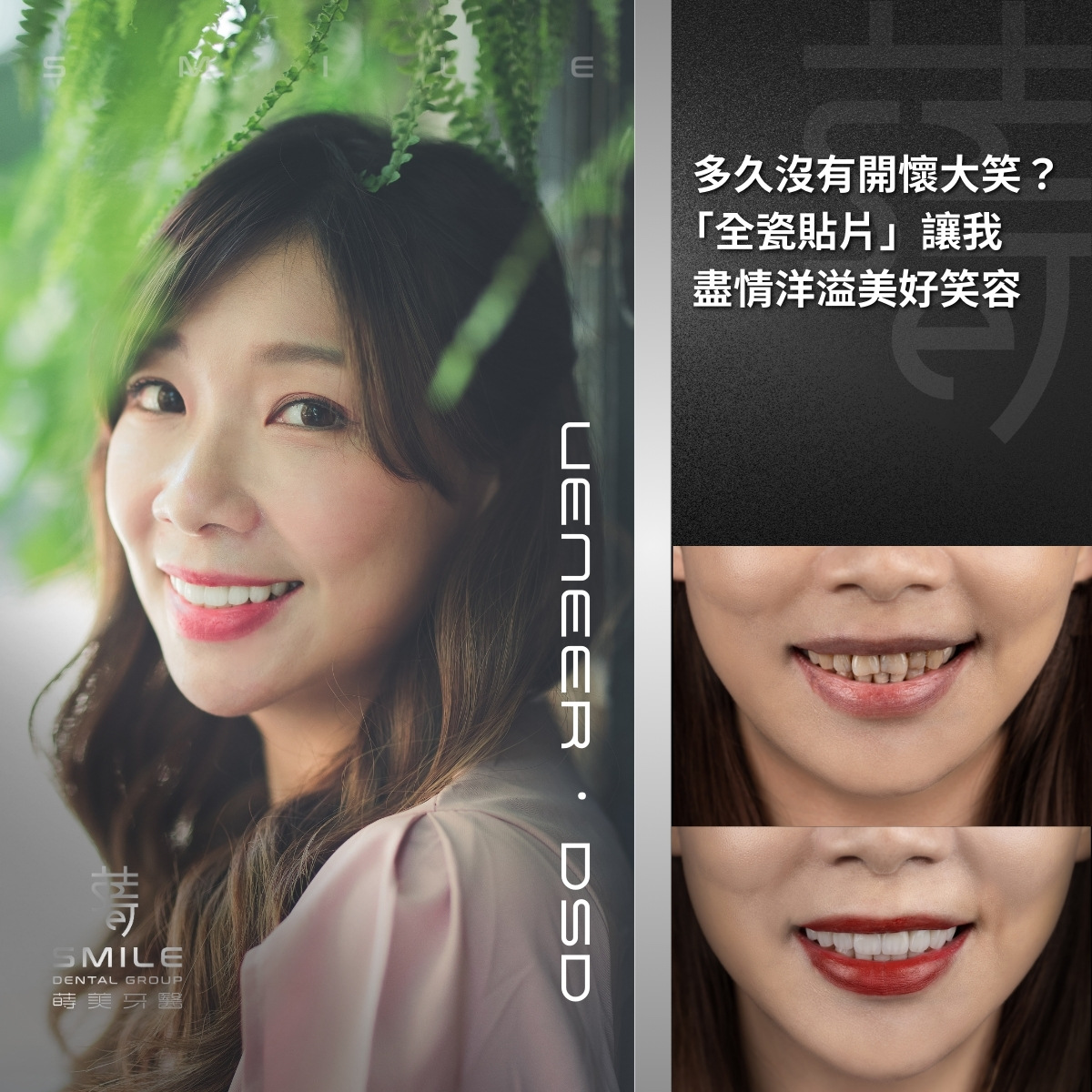 全瓷貼片案例-台北陶瓷貼片推薦-蒔美牙醫-14