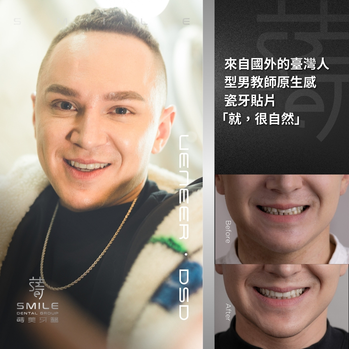 全瓷貼片案例-台北陶瓷貼片推薦-蒔美牙醫-7
