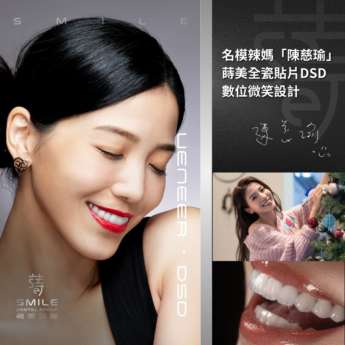 全瓷貼片案例-台北陶瓷貼片推薦-蒔美牙醫-9-名模陳慈瑜