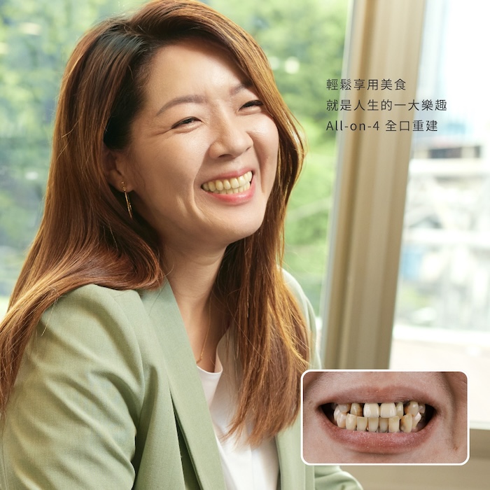 輕鬆享用美食，就是人生的一大樂趣，All-on-4 全口重建