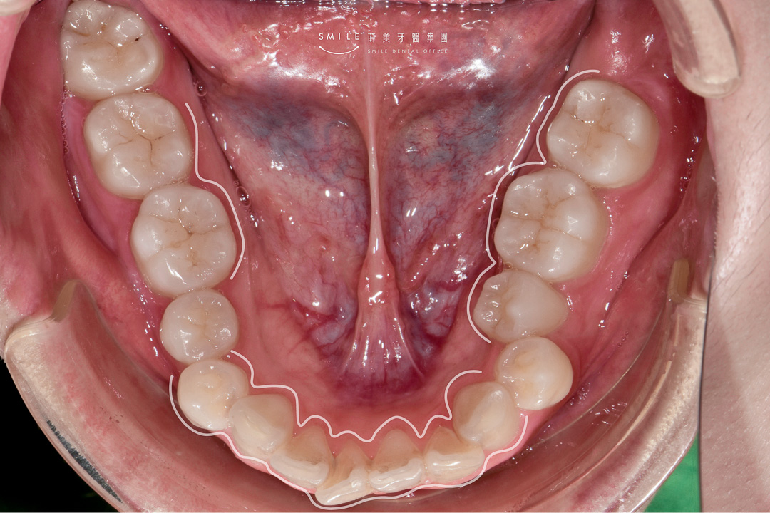 隱適美隱形矯正案例 蒔美牙醫#106-17