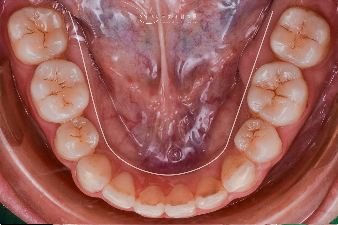 隱適美隱形矯正案例 蒔美牙醫#106-18