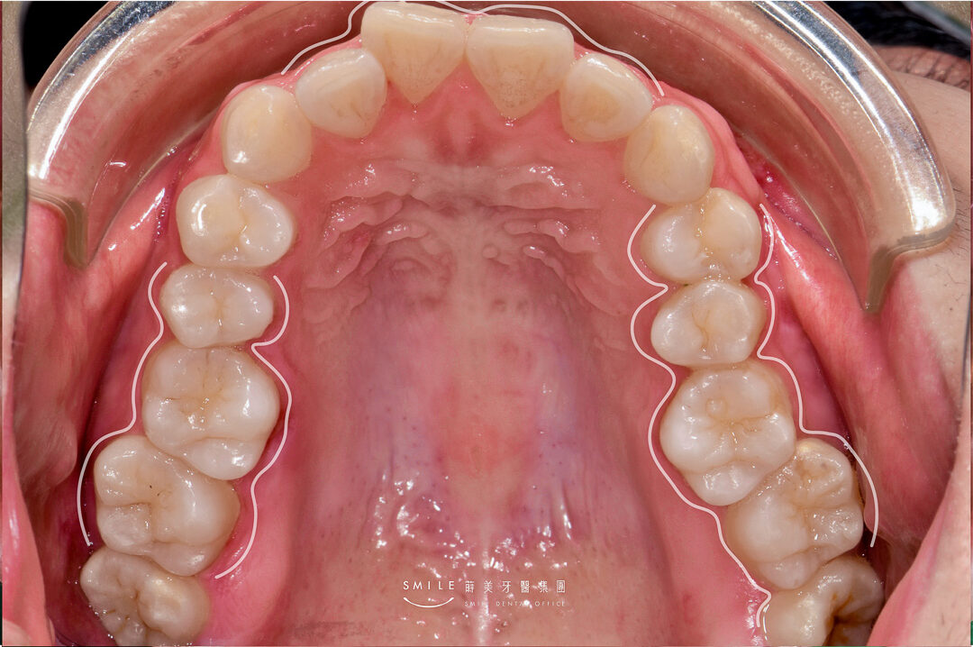 隱適美隱形矯正案例 蒔美牙醫#106-19