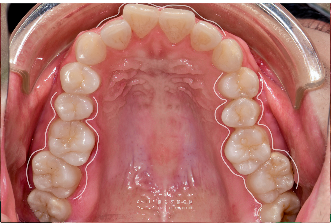 隱適美隱形矯正案例 蒔美牙醫#106-19