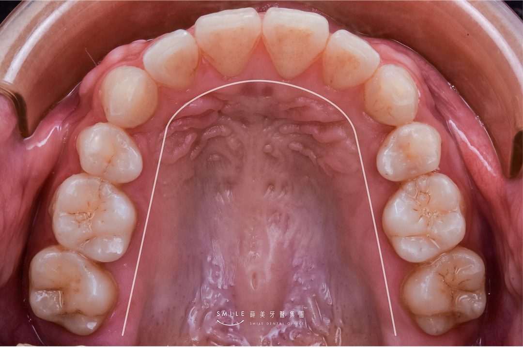 隱適美隱形矯正案例 蒔美牙醫#106-20