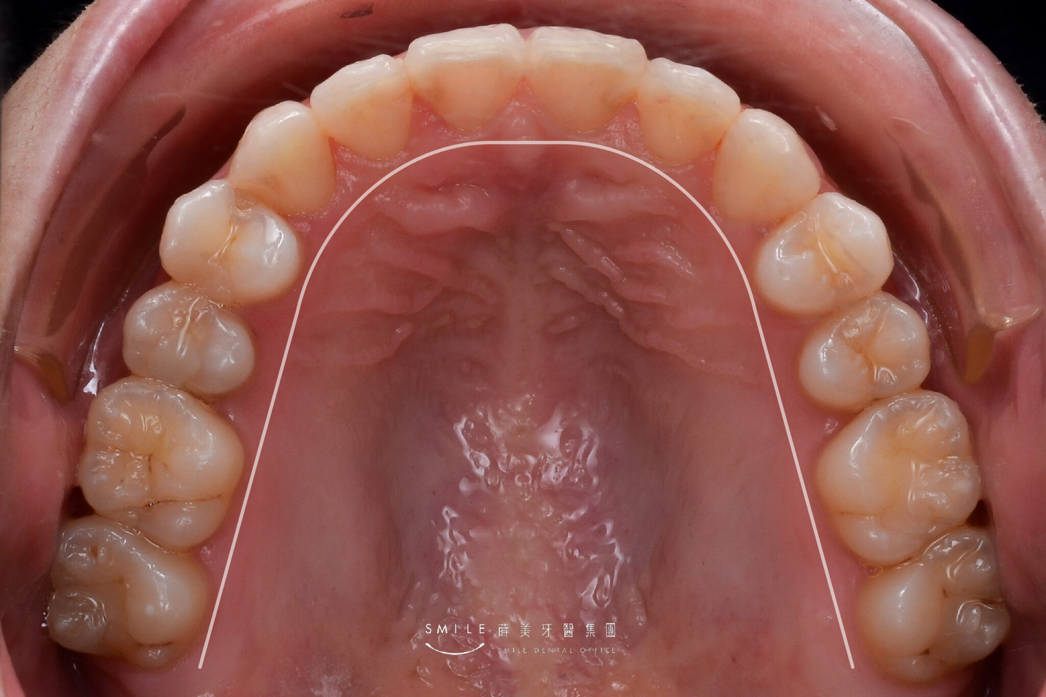 隱適美隱形矯正案例#105矯正輪廓線