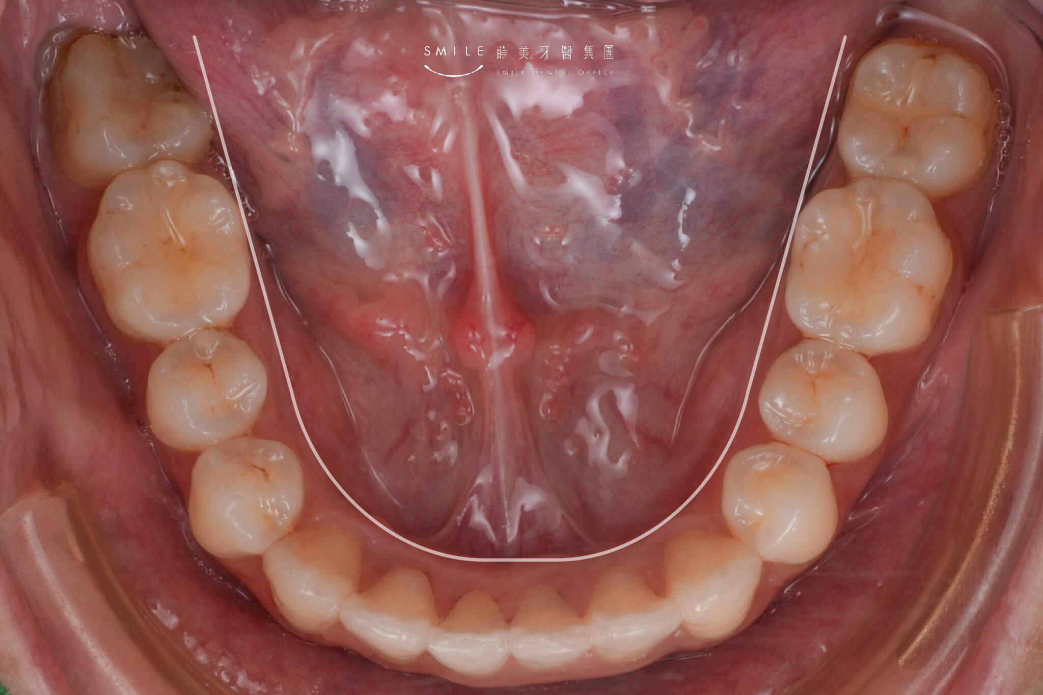 隱適美隱形矯正案例#105矯正輪廓線_2
