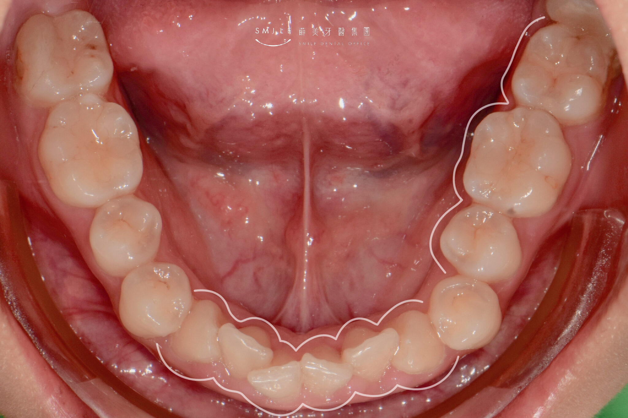 隱適美隱形矯正案例#105矯正輪廓線_3