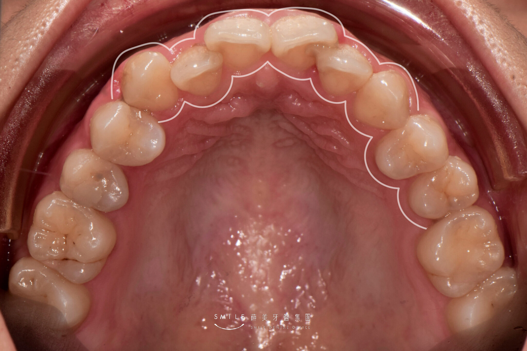 隱適美隱形矯正案例#105矯正輪廓線_4