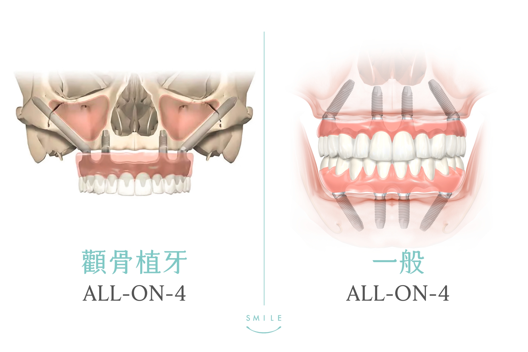 顴骨植牙All-on-4比較
