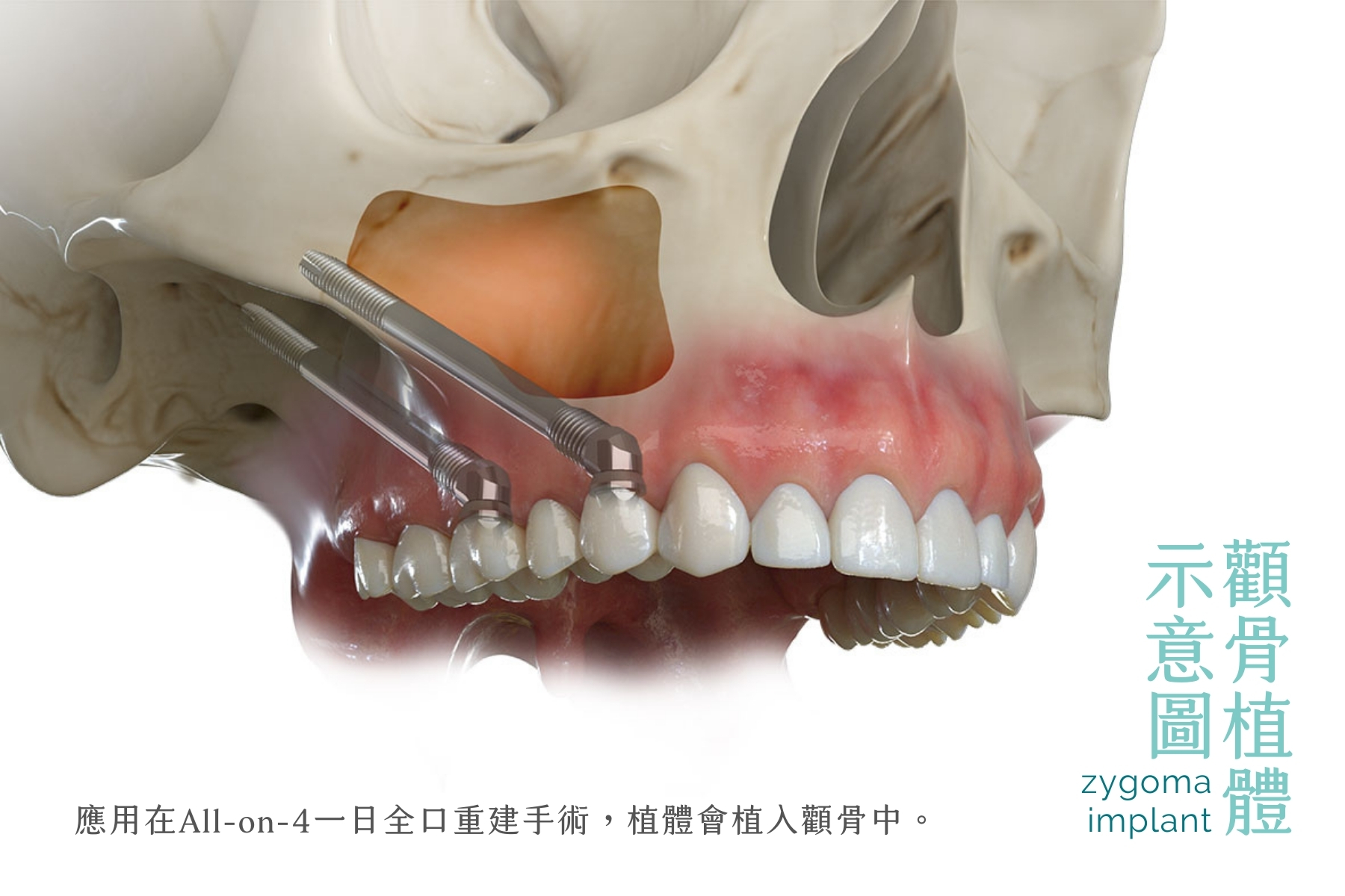 顴骨植體示意圖