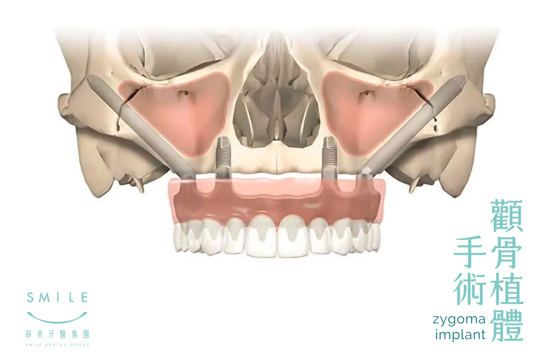 zygoma implant