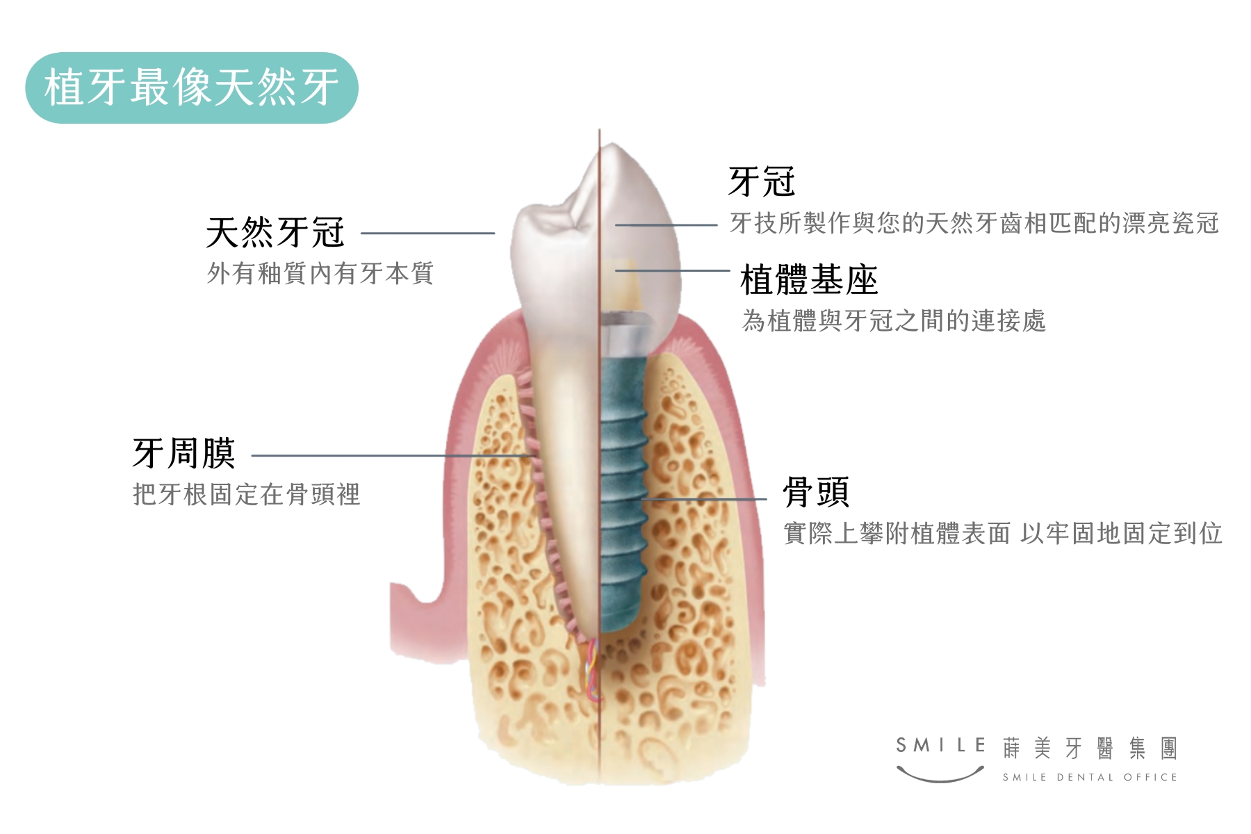 植牙最像天然牙