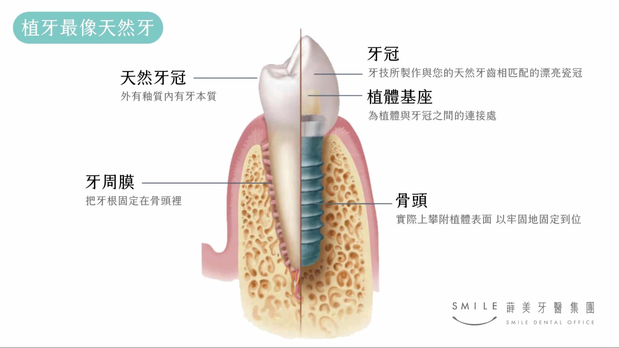 植牙最像天然牙