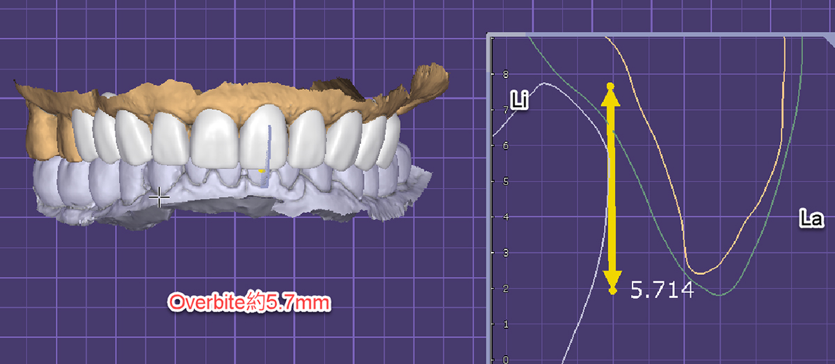 謝金堆DSD overjet overbite-1