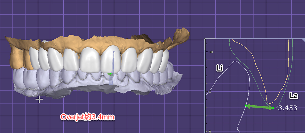 謝金堆DSD overjet overbite-2