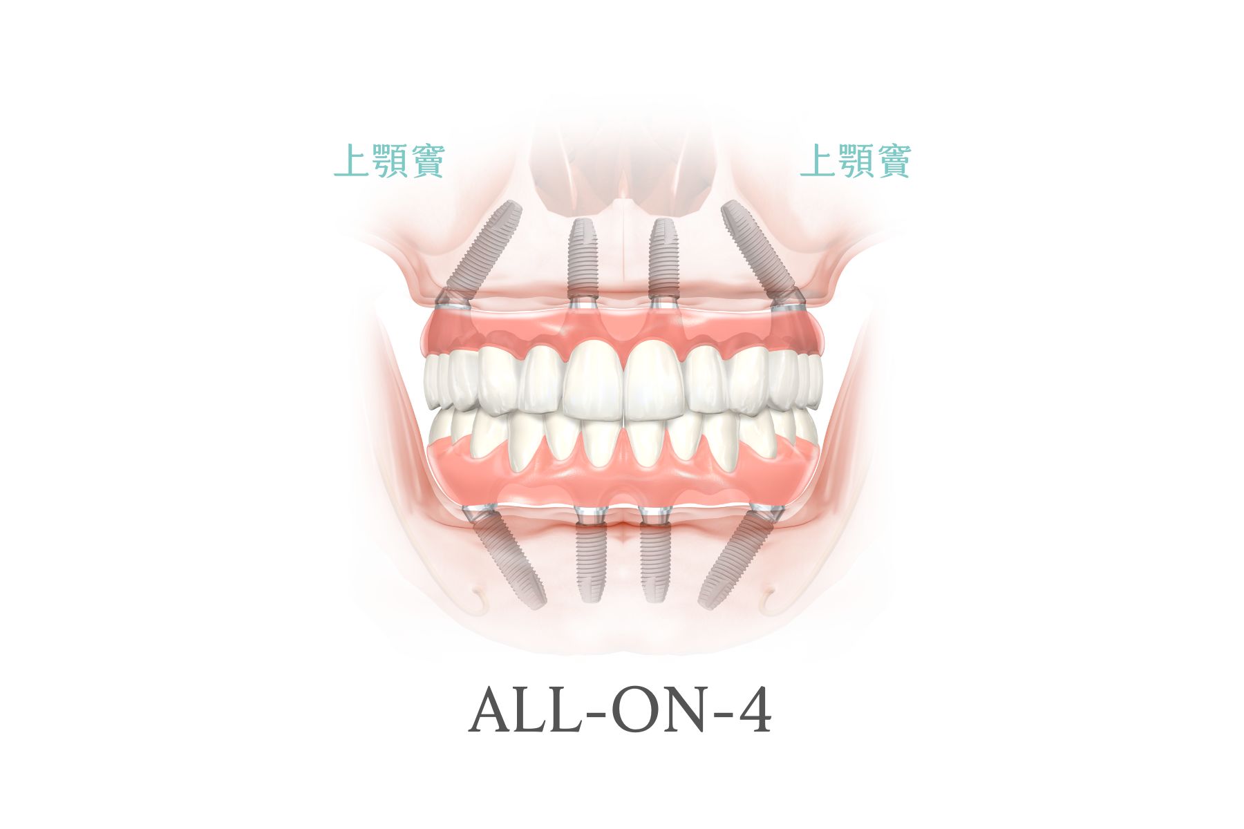 All-on-4植牙