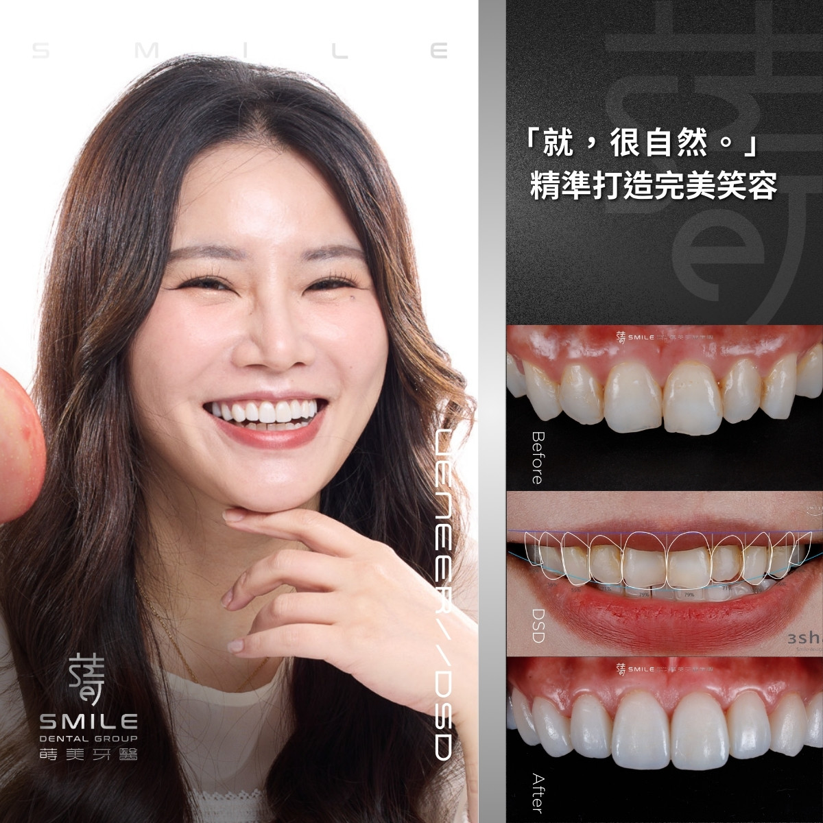 全瓷貼片案例-台北全瓷貼片推薦-蒔美牙醫-蘋果-1_v2