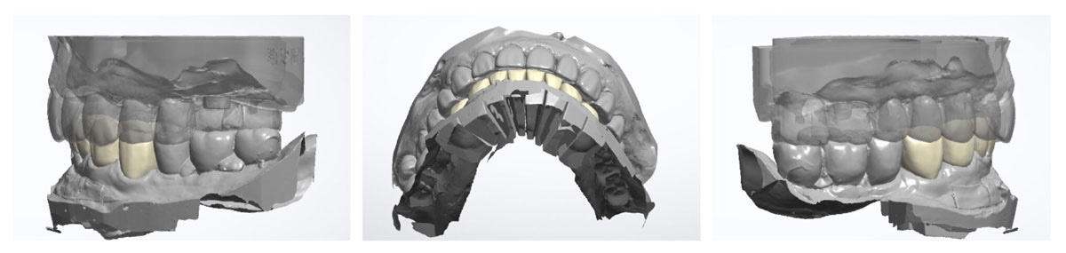 謝-DSD-MOCK-UP上顎-scaled-1